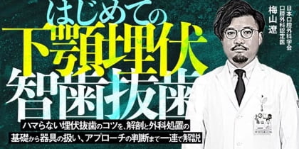 はじめての下顎埋伏智歯抜歯
